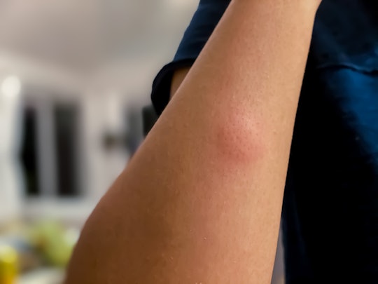 A childrens arm with signs of Lyme Disease