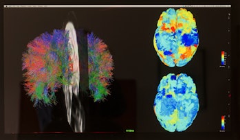 TORONTO - APRIL 25 - White matter fibre tracts (left) and  fMRI images of reporter Jennifer Wells's ...