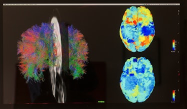 TORONTO - APRIL 25 - White matter fibre tracts (left) and  fMRI images of reporter Jennifer Wells's ...