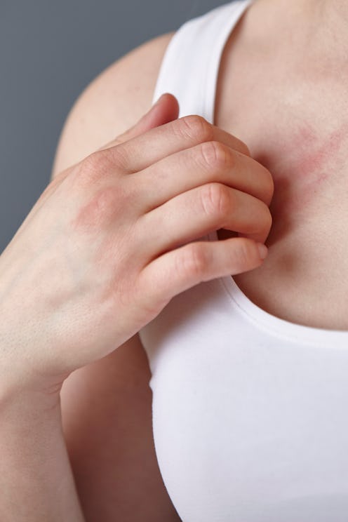 A woman scratches at anxiety-induced hives on her chest.