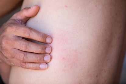 Some hives on skin. Hives are caused by histamine release, which can be triggered by stress. 