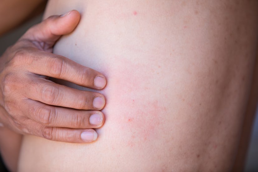 Some hives on skin. Hives are caused by histamine release, which can be triggered by stress. 