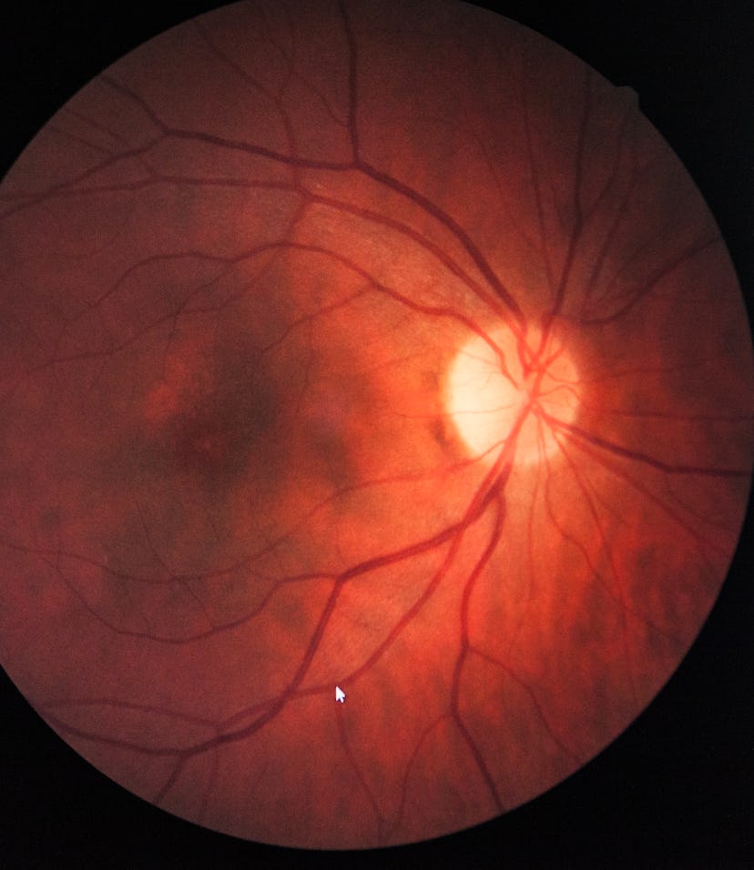 Fundus oculi of a patient suffering from retinal edema. (Photo by: BSIP/Universal Images Group via G...