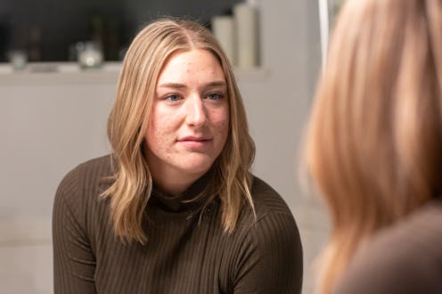 SOUTH ROY, UTAH, UNITED STATES - DECEMBER 8, 2019 -
A WOMAN with severe acne felt that she wasnt wo...