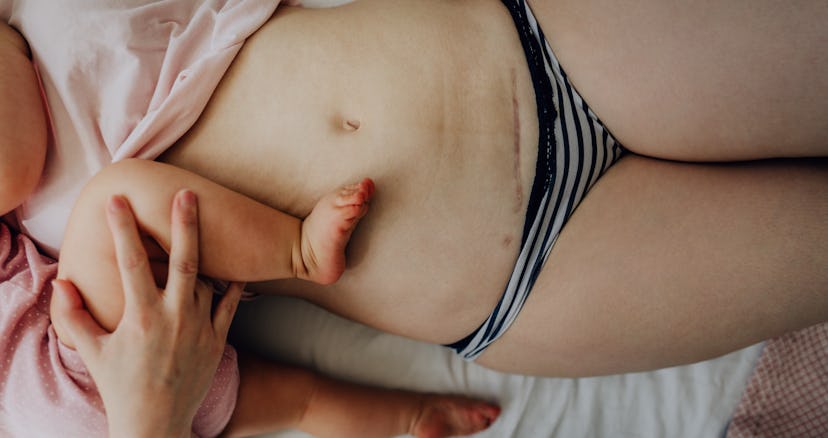 Having sex after a C-section isn't something you can do right away