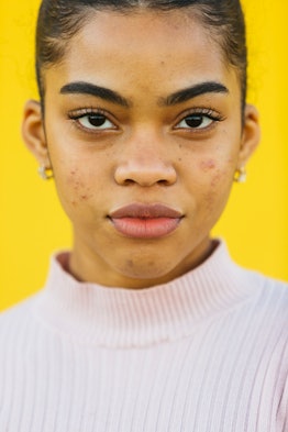 Portrait of a Young latin girl with acne posing in front of a yellow background