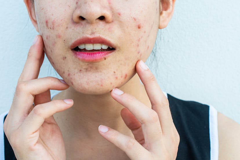 Inflamed acne consists of swelling, redness, and pores that are deeply clogged with bacteria, oil, a...