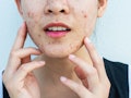 Inflamed acne consists of swelling, redness, and pores that are deeply clogged with bacteria, oil, a...