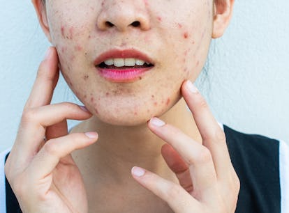 Inflamed acne consists of swelling, redness, and pores that are deeply clogged with bacteria, oil, a...