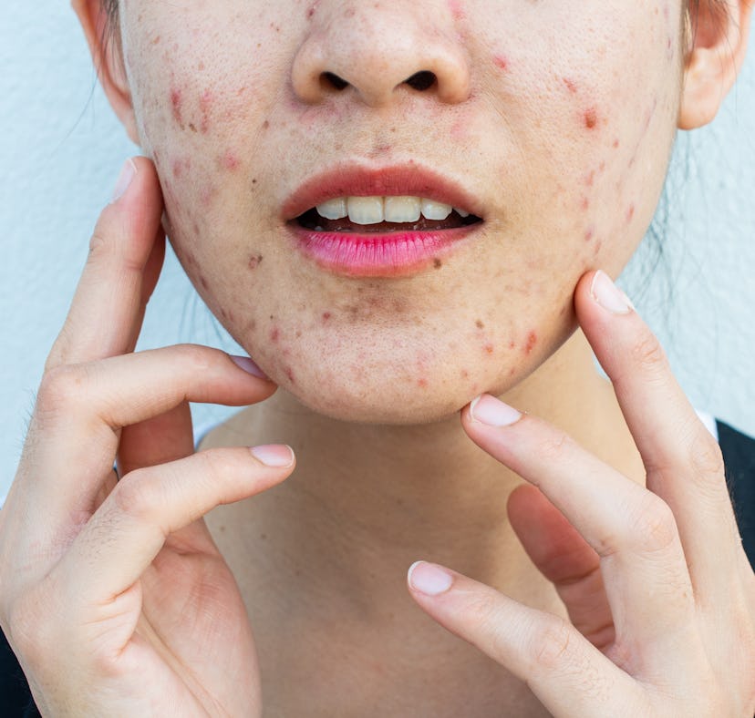 Inflamed acne consists of swelling, redness, and pores that are deeply clogged with bacteria, oil, a...
