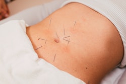 Acupuncture fertility points include some places on the abdomen, as shown in this photo of a woman's...