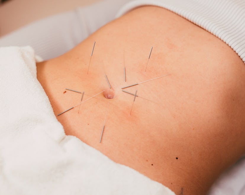 Acupuncture fertility points include some places on the abdomen, as shown in this photo of a woman's...