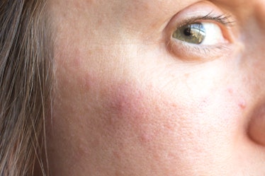 Woman with pimples on face. This closeup image of skin shows adult acne, zits, and skin problems.