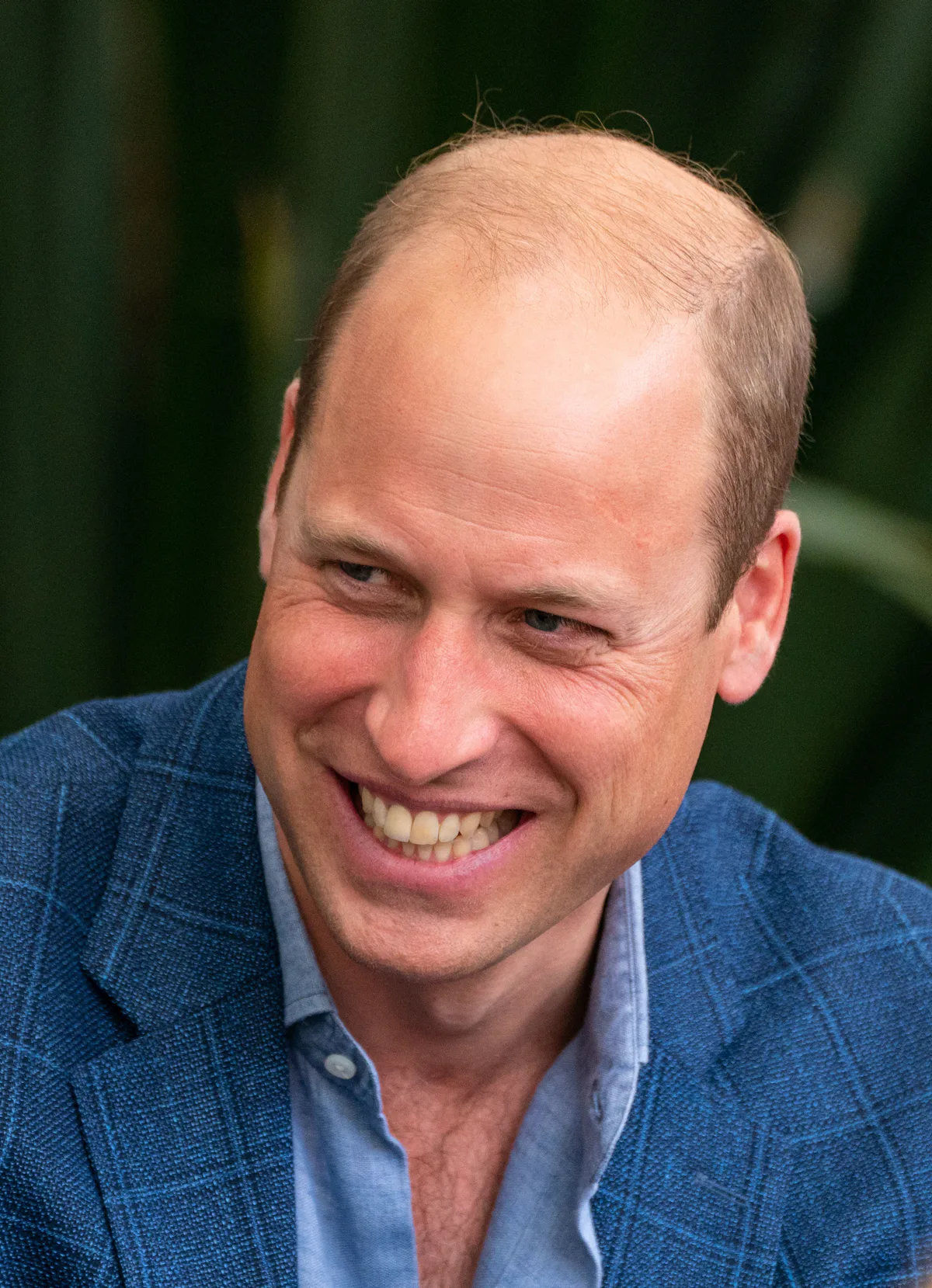 Where Art Thou Hair Transplants? – Celebrity Land International