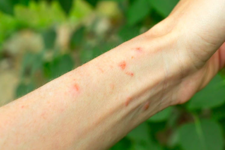 Skin rash on arm from poison ivy plant. Poison ivy blisters on human arm from gardening outdoors.