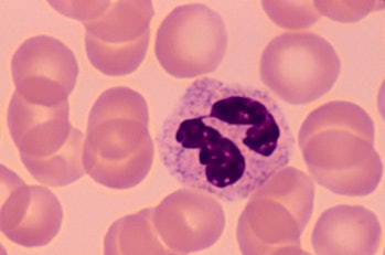 NORMAL BLOOD SMEAR  (human), Red Blood Cells (erythrocytes) and a White Blood Cell.