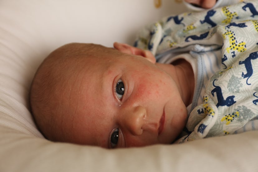 picture of baby with baby acne / neonatal acne on their cheek 