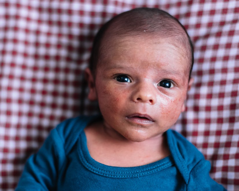 baby with baby or neonatal acne lying on gingham picnic blanket