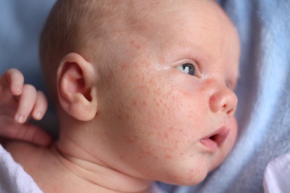 picture of Newborn baby with a case of baby acne, neonatal acne