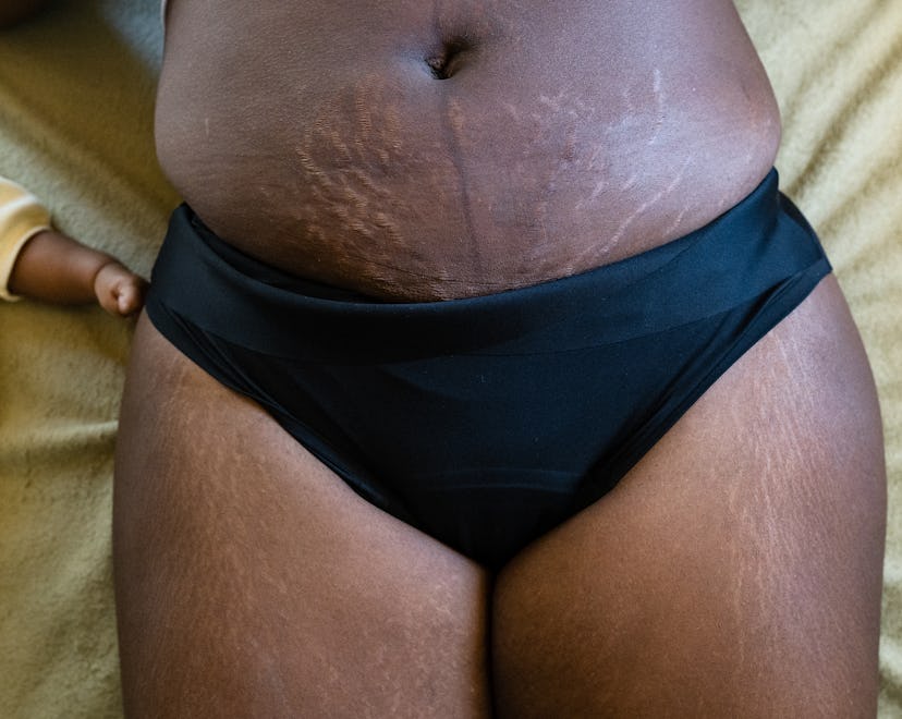 Stretch marks on postpartum stomach