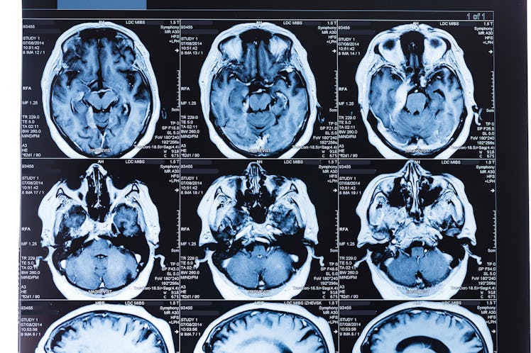 Magnetic resonance imaging (MRI) scans of the human brain.