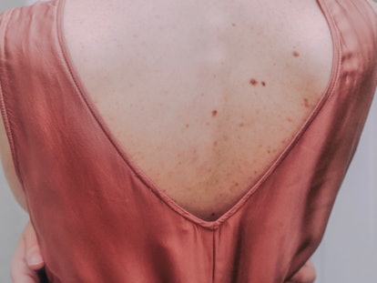 woman with body acne, back acne, faces away from the camera