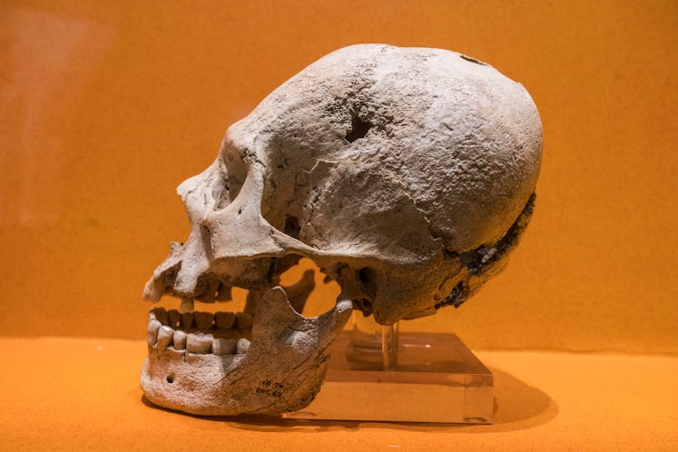 A skull from the ruins of Monte Alban showing cranial deformation and trepanation surgery. Monte Alb...