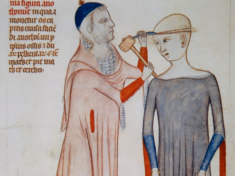 Illustration of trepanation. Miniature. 14th century. Treatise on anatomy by Mondino de Liuzzi (1270...