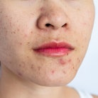 Conceptual shot of Acne and Problem Skin on female face.