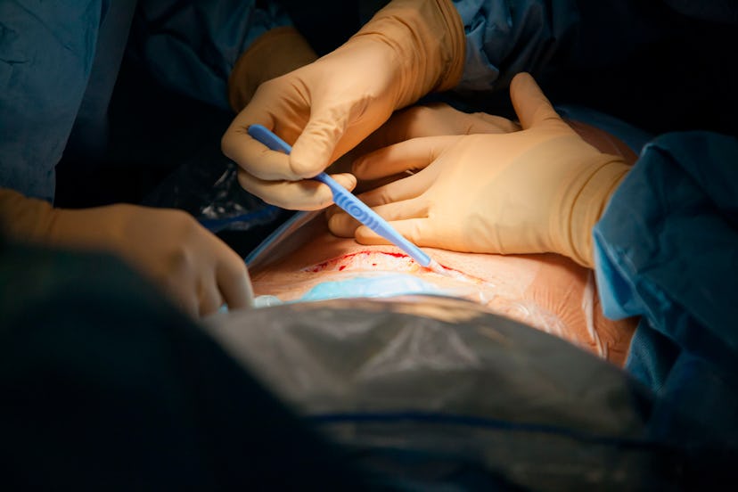 C-section incision; surgical tape will be used to keep incinsion closed
