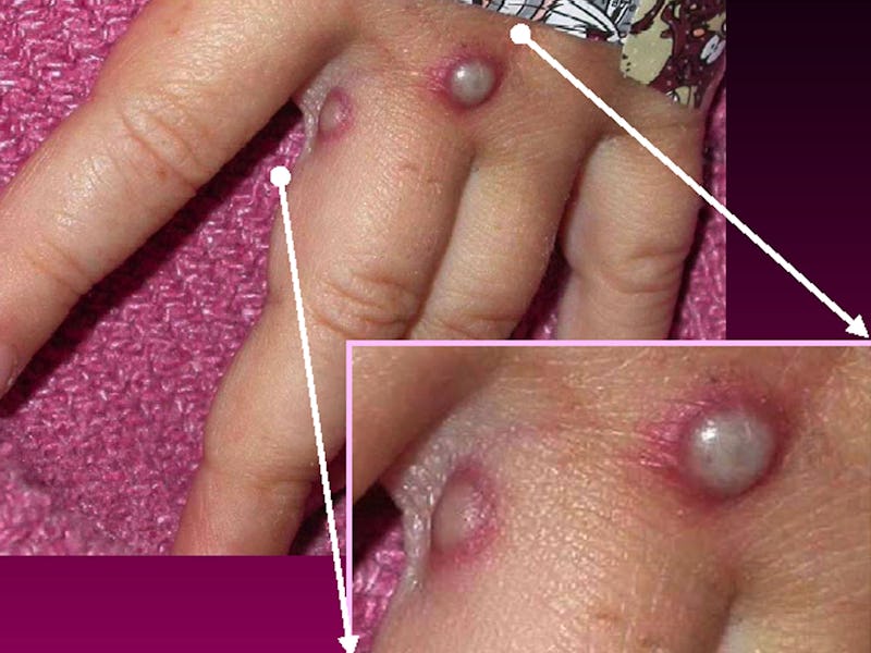 UNDATED ? MAY 27: In this Centers for Disease Control and Prevention handout graphic, symptoms of o...