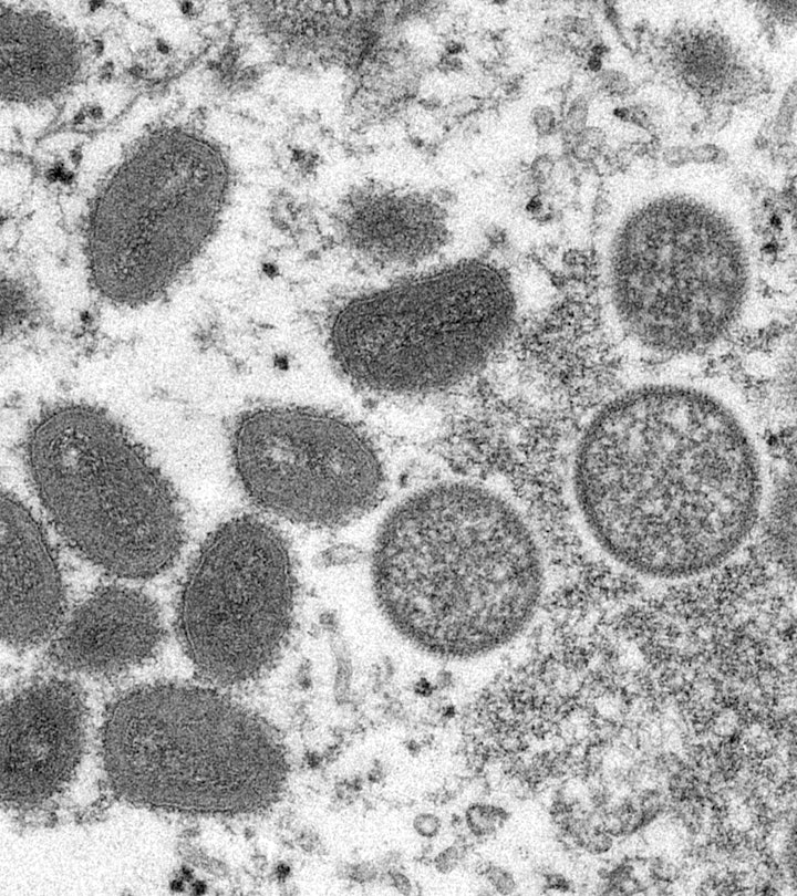 Electron microscope image of various virions (virus particles) of the monkeypox virus taken from hum...