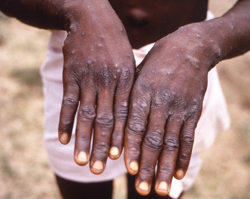 Close-up of monkeypox lesions on the hands of a patient.