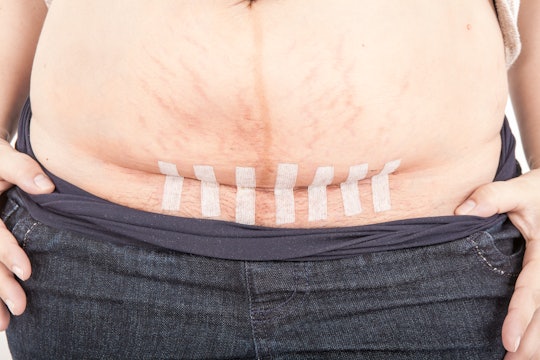 A post-cesarean incision is closed with strips of medical tape during the healing stage. The area ma...