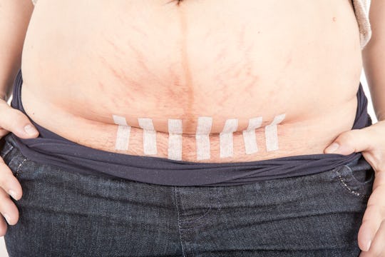 Keloid C Section Scars Causes Removal Options