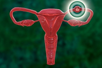 Ectopic pregnancy, illustration. This is a pregnancy where the embryo implants outside the uterus, u...