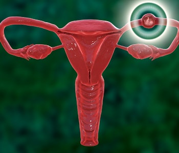 Ectopic pregnancy, illustration. This is a pregnancy where the embryo implants outside the uterus, u...