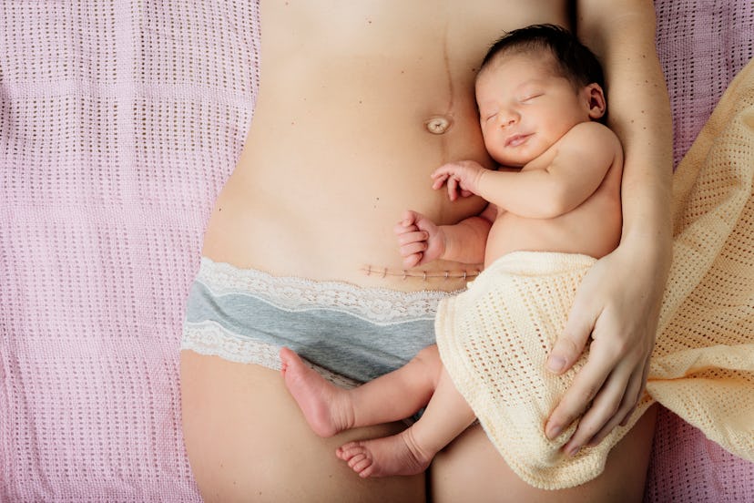 Mother and baby with a c-section scar closed by staples in an article about how to care for your c-s...