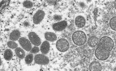 Electron microscope image of various virions (virus particles) of the monkeypox virus taken from hum...