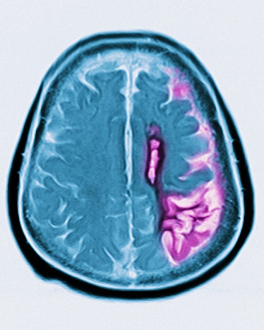 Cerebral atrophy. Parietal cortico-sub-cortical atrophies (aftereffects of left, frontoparietal pare...