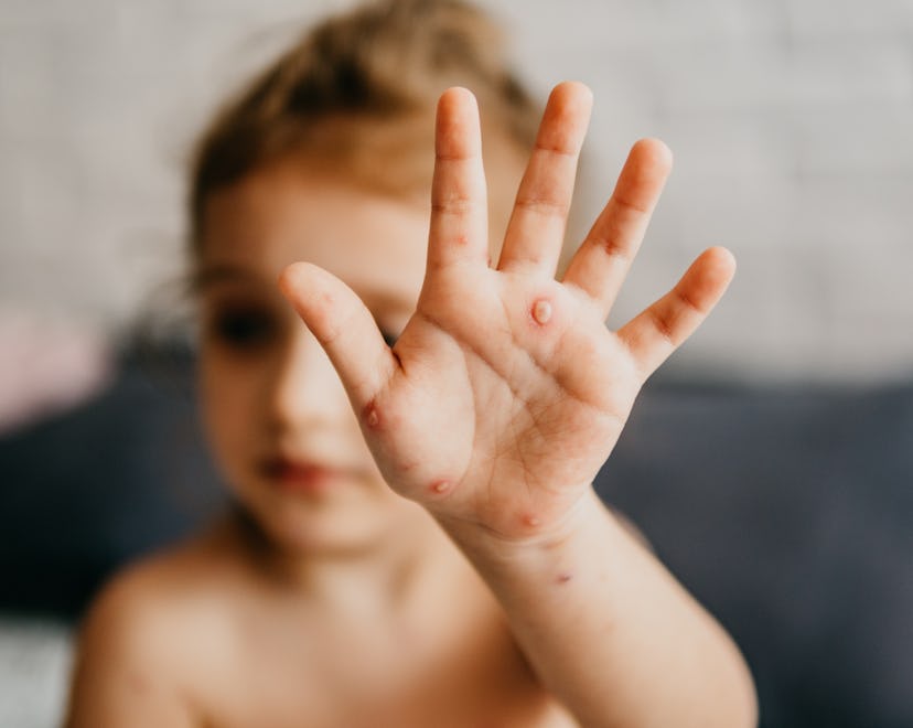 photo of a child with monkeypox in a piece about the monkeypox outbreak 2022 signs symptoms vaccines...