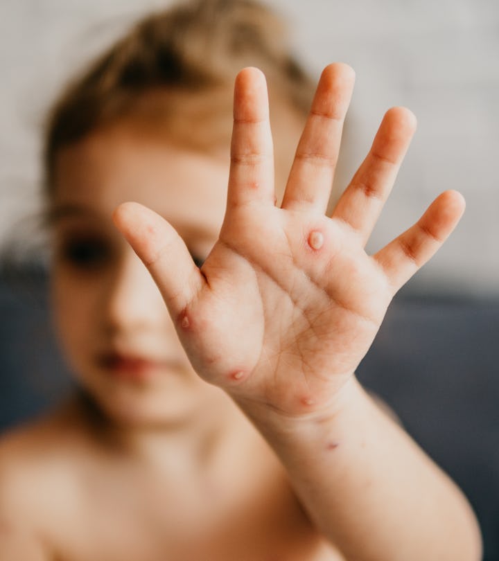 photo of a child with monkeypox in a piece about the monkeypox outbreak 2022 signs symptoms vaccines...