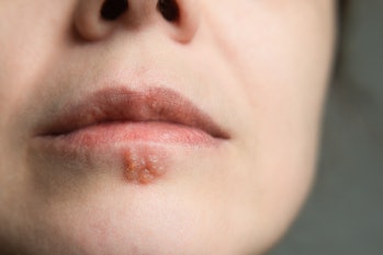 A stock photo of a woman with herpes viral cold sore on her lip and mouth. Antiviral cream can relie...