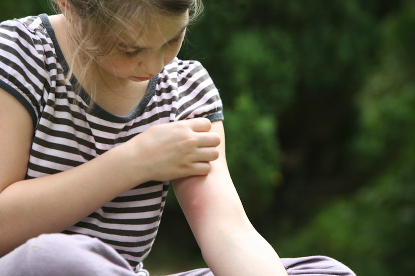 girl with mosquito bite, in an article about if you can be allergic to mosquito bites
