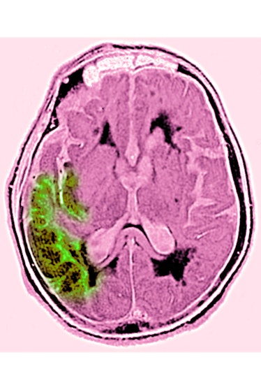 Stroke due to arterial thrombosis in the right hemisphere, seen by a radial CT scan of the brain. (P...