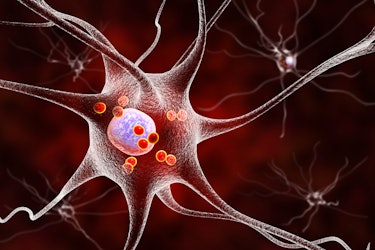 Parkinsons disease nerve cells. Computer illustration of human nerve cells affected by Lewy bodies (...