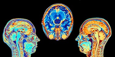 Brain scans like these can't be used to diagnose Alzheimer's though they can rule out other causes.