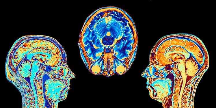 Brain scans like these can't be used to diagnose Alzheimer's though they can rule out other causes.