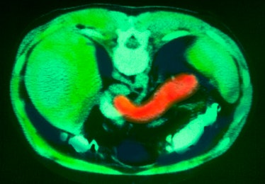 Healthy Pancreas Of A Young Patient. (Photo By BSIP/UIG Via Getty Images)