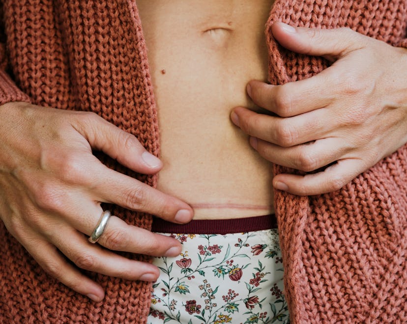A scar on the abdomen, in a story about healing from a hysterectomy and hysterectomy recovery tips